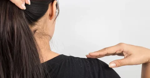 গরমেও মাথা ভর্তি খুশকি? দূর করবেন যেভাবে